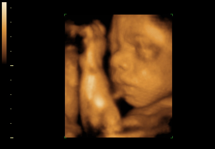 3D ultrasound image at 27 weeks